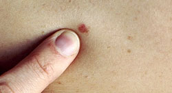 Is Mole Removal Safe